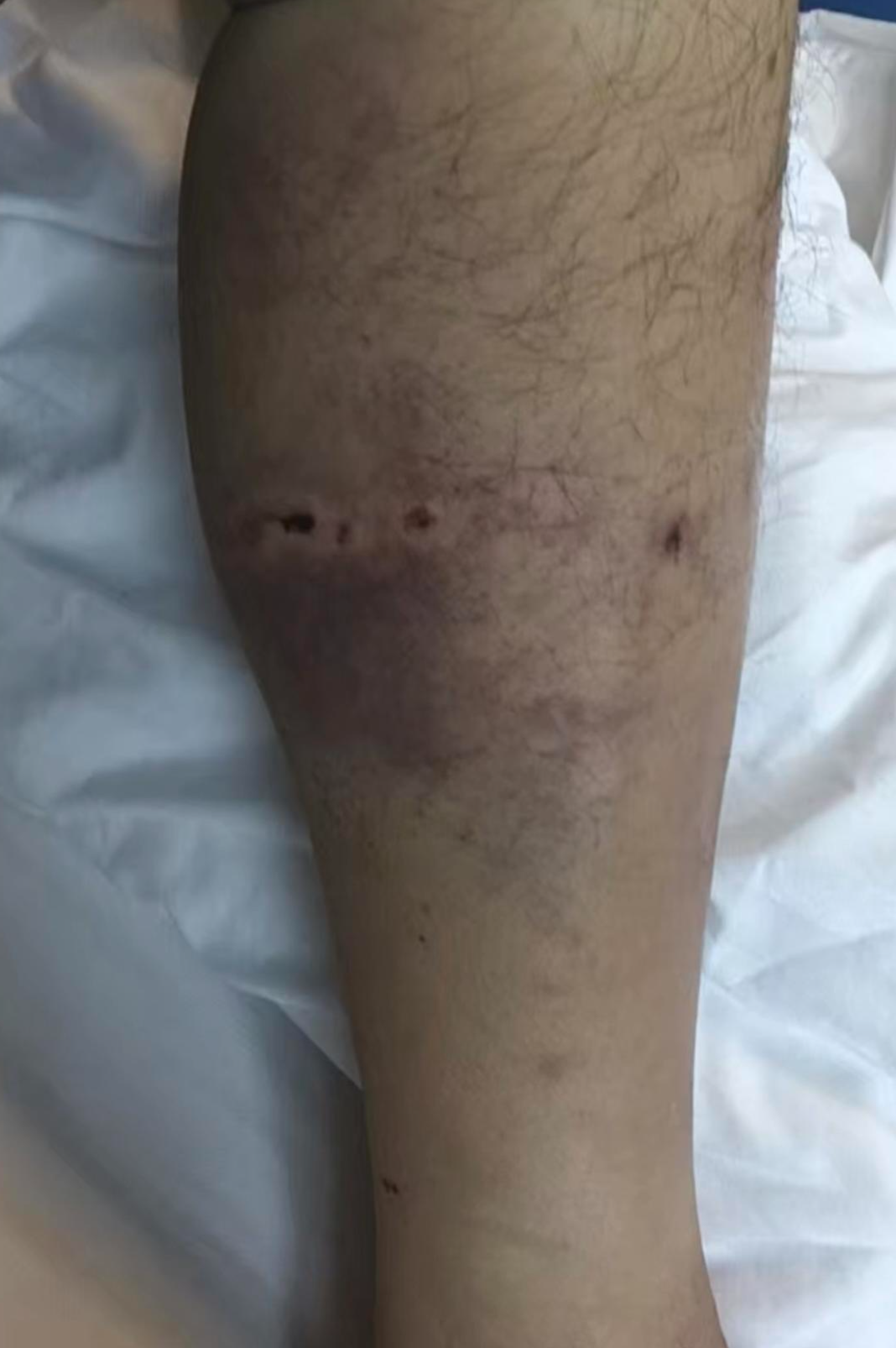 男子采菌遭黑熊一巴掌打下山昏迷