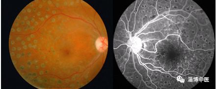眼底照相能检查出什么【临床医讯】眼底照相仪——有效检测糖尿病、高血压等疾病的视网膜病变_https://www.jmylbn.com_新闻资讯_第6张