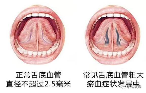 吓死了 舌头下面有两条蚯蚓 全网搜