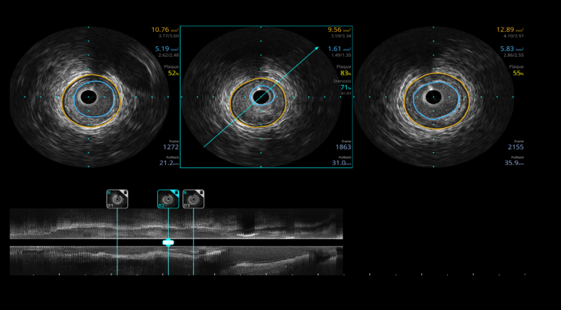 开立超声怎么导出图像开立医疗高清血管内超声诊断系统获批NMPA!_https://www.jmylbn.com_新闻资讯_第11张