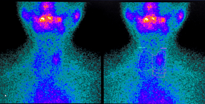 d-spect怎么检查专科分享｜核医学SPECT检查显像的优势及注意事项_https://www.jmylbn.com_新闻资讯_第2张