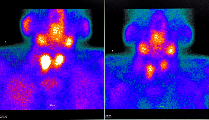 d-spect怎么检查专科分享｜核医学SPECT检查显像的优势及注意事项_https://www.jmylbn.com_新闻资讯_第5张