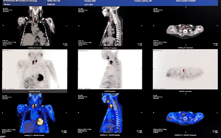 d-spect怎么检查专科分享｜核医学SPECT检查显像的优势及注意事项_https://www.jmylbn.com_新闻资讯_第6张