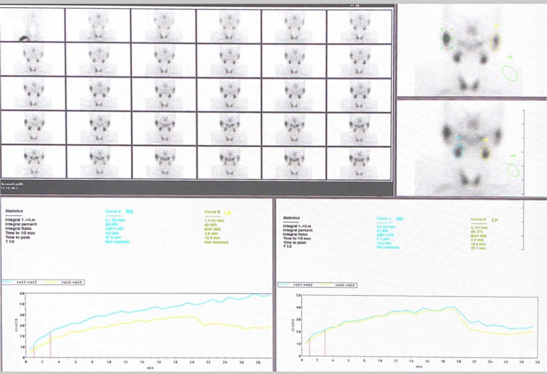 d-spect怎么检查专科分享｜核医学SPECT检查显像的优势及注意事项_https://www.jmylbn.com_新闻资讯_第3张