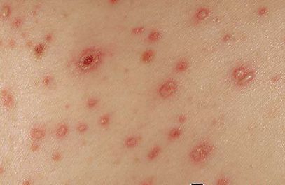 肚脐周围老是出皮疹流水是什么原因 广州华兴康复医院皮肤科 微信公众号文章阅读 Wemp