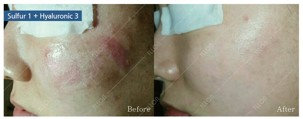 illon微针痘痘1次 水光3次效果↑sulfur针对炎症痘痘缓解痘印疤痕