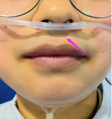 吸氧管怎么连接简单的鼻导管吸氧中，隐藏的N多细节_https://www.jmylbn.com_新闻资讯_第8张