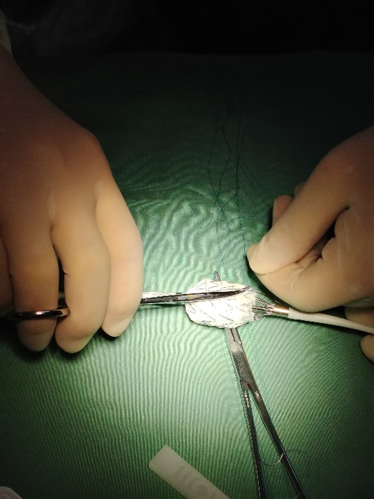 单猪尾支架怎么放【腹具匠新】吴华平教授团队：ENDURANT IIs 分叉支架开窗束径保留 IMA 治疗腹主动脉穿透性溃疡_https://www.jmylbn.com_新闻资讯_第27张