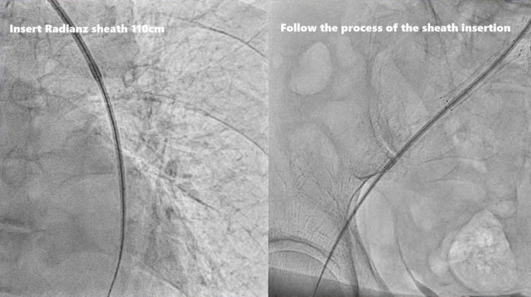 动脉长鞘怎么置入桡胜一筹丨原口拓也：经桡动脉入路在下肢动脉疾病腔内治疗中的优势——RADIANZ应用经验_https://www.jmylbn.com_新闻资讯_第23张