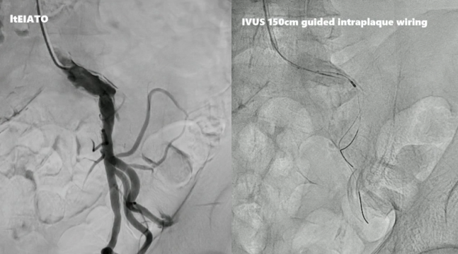 动脉长鞘怎么置入桡胜一筹丨原口拓也：经桡动脉入路在下肢动脉疾病腔内治疗中的优势——RADIANZ应用经验_https://www.jmylbn.com_新闻资讯_第33张