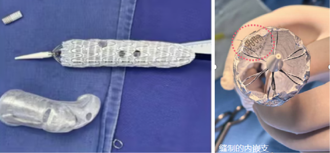 gore医疗怎么样「胸有乾坤」千钧一发 转危为安——Gore TBE治疗急诊破裂TAA一例_https://www.jmylbn.com_新闻资讯_第6张