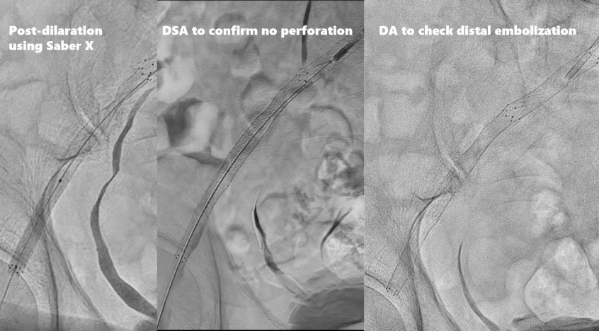 动脉长鞘怎么置入桡胜一筹丨原口拓也：经桡动脉入路在下肢动脉疾病腔内治疗中的优势——RADIANZ应用经验_https://www.jmylbn.com_新闻资讯_第26张