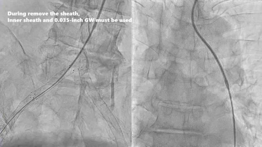动脉长鞘怎么置入桡胜一筹丨原口拓也：经桡动脉入路在下肢动脉疾病腔内治疗中的优势——RADIANZ应用经验_https://www.jmylbn.com_新闻资讯_第27张