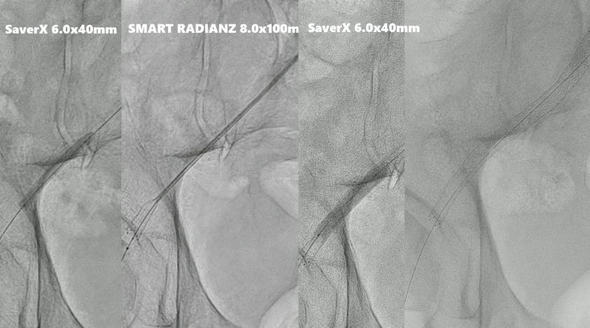 动脉长鞘怎么置入桡胜一筹丨原口拓也：经桡动脉入路在下肢动脉疾病腔内治疗中的优势——RADIANZ应用经验_https://www.jmylbn.com_新闻资讯_第31张