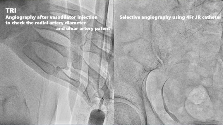 动脉长鞘怎么置入桡胜一筹丨原口拓也：经桡动脉入路在下肢动脉疾病腔内治疗中的优势——RADIANZ应用经验_https://www.jmylbn.com_新闻资讯_第22张