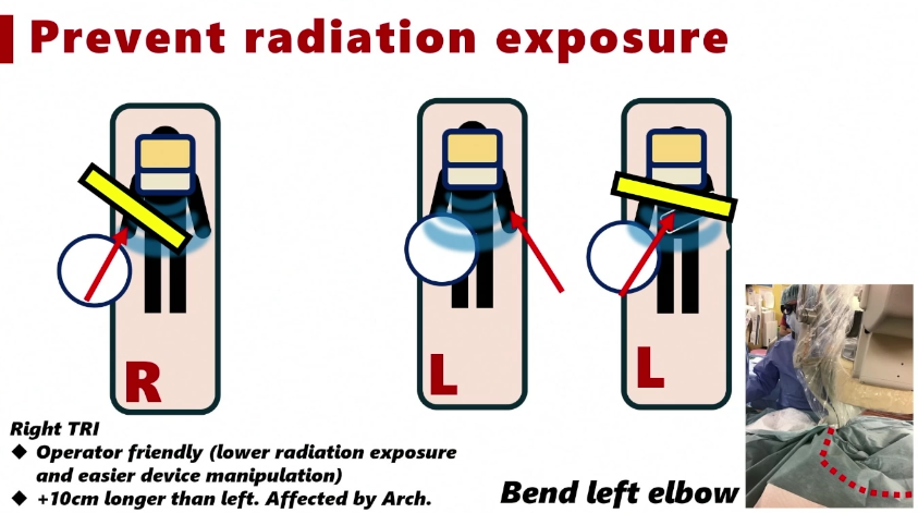 动脉长鞘怎么置入桡胜一筹丨原口拓也：经桡动脉入路在下肢动脉疾病腔内治疗中的优势——RADIANZ应用经验_https://www.jmylbn.com_新闻资讯_第16张