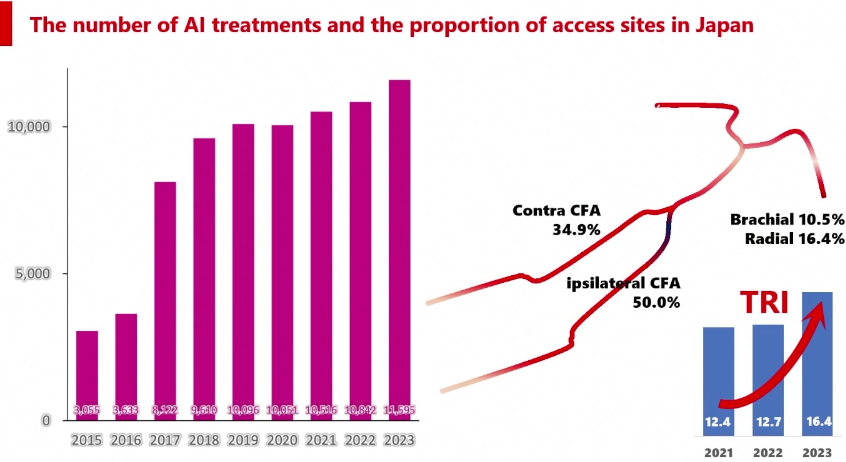 动脉长鞘怎么置入桡胜一筹丨原口拓也：经桡动脉入路在下肢动脉疾病腔内治疗中的优势——RADIANZ应用经验_https://www.jmylbn.com_新闻资讯_第8张