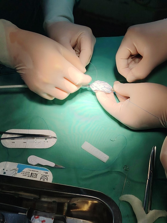 单猪尾支架怎么放【腹具匠新】吴华平教授团队：ENDURANT IIs 分叉支架开窗束径保留 IMA 治疗腹主动脉穿透性溃疡_https://www.jmylbn.com_新闻资讯_第26张