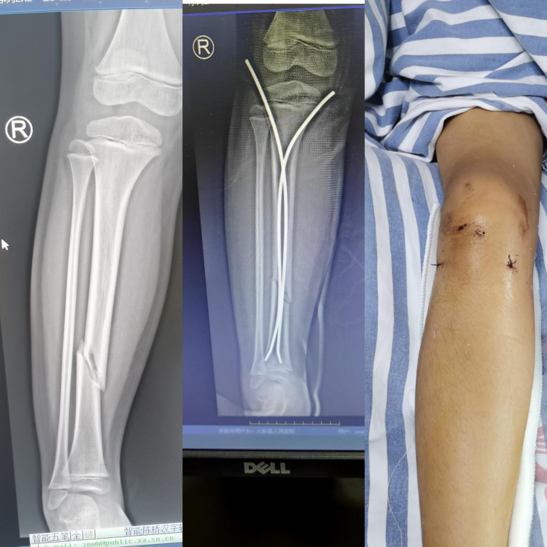 肋骨固定板怎么拆骨折里的钢板螺钉：是时候说“再见”了吗？—— 关于内固定物取与不取的全面解读_https://www.jmylbn.com_新闻资讯_第5张