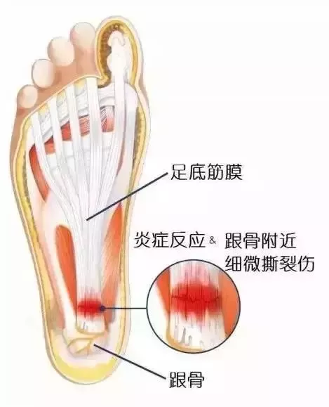 三招搞定足跟痛 健康 第2張