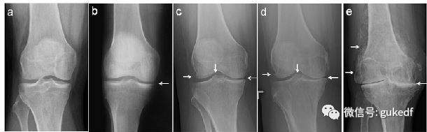 膝关节疼--到底是滑膜炎、骨质增生、还是关节炎？