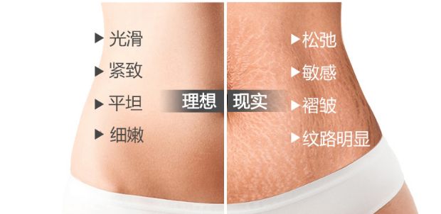 妊娠纹“偏爱”哪些孕妈？一旦长了就去不掉吗？