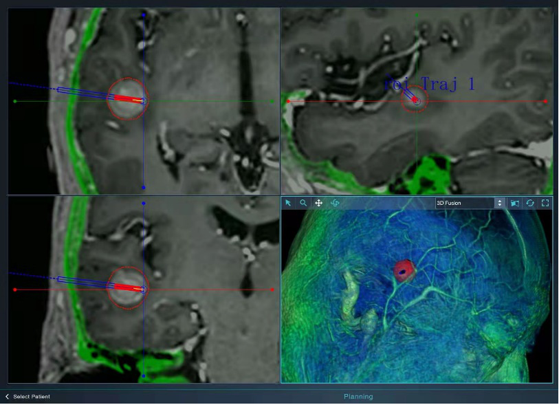 精密注塑成型：揭秘腫瘤激光消融器的研發過程的圖1