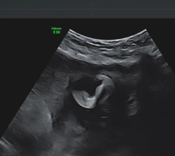 VOlusonE什么彩超机世界顶级四维彩超机美国 GE Voluson E10 BT20金标版落户吉林省吉林中西医结合医院_https://www.jmylbn.com_新闻资讯_第4张