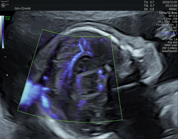 VOlusonE什么彩超机世界顶级四维彩超机美国 GE Voluson E10 BT20金标版落户吉林省吉林中西医结合医院_https://www.jmylbn.com_新闻资讯_第11张