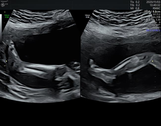 VOlusonE什么彩超机世界顶级四维彩超机美国 GE Voluson E10 BT20金标版落户吉林省吉林中西医结合医院_https://www.jmylbn.com_新闻资讯_第6张