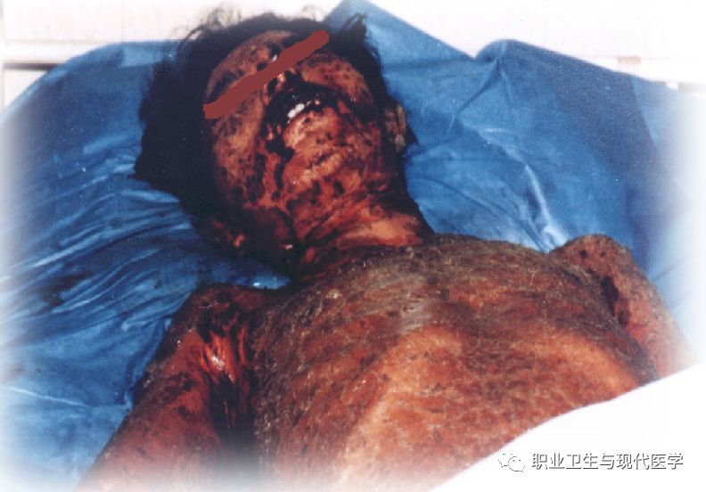 【《职业病防治法》宣传周】第五讲:剥皮毁肝灭肾的夺命水