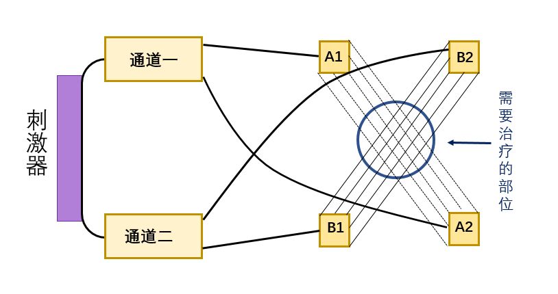 中频为什么能镇痛【干货】中频电疗(Medium Frequency)_https://www.jmylbn.com_新闻资讯_第11张