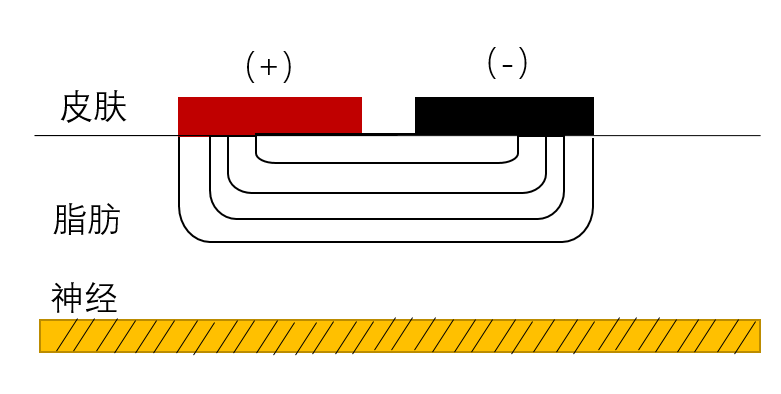 中频为什么能镇痛【干货】中频电疗(Medium Frequency)_https://www.jmylbn.com_新闻资讯_第9张