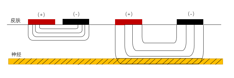 中频为什么能镇痛【干货】中频电疗(Medium Frequency)_https://www.jmylbn.com_新闻资讯_第8张