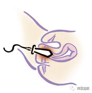 盆底电刺激治疗的原理——必须收藏！