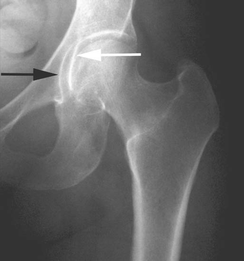 关节钳怎么用[易错与误判] “髋关节撞击综合征：凸轮型与钳型”的相关临床知识、影像表现及鉴别诊断（建议收藏）_https://www.jmylbn.com_新闻资讯_第5张