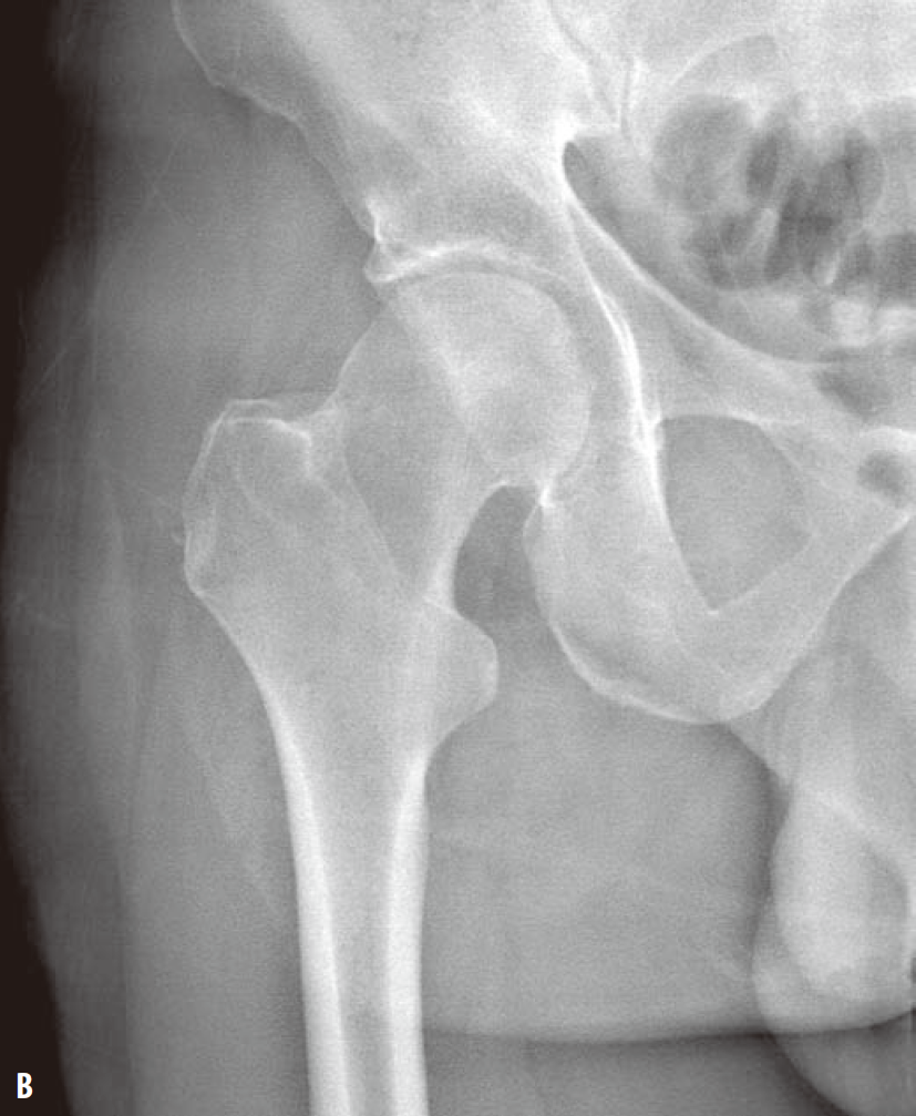 关节钳怎么用[易错与误判] “髋关节撞击综合征：凸轮型与钳型”的相关临床知识、影像表现及鉴别诊断（建议收藏）_https://www.jmylbn.com_新闻资讯_第3张