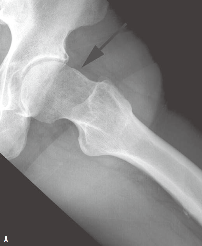 关节钳怎么用[易错与误判] “髋关节撞击综合征：凸轮型与钳型”的相关临床知识、影像表现及鉴别诊断（建议收藏）_https://www.jmylbn.com_新闻资讯_第2张