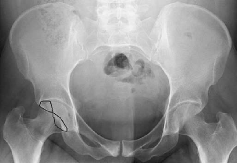 关节钳怎么用[易错与误判] “髋关节撞击综合征：凸轮型与钳型”的相关临床知识、影像表现及鉴别诊断（建议收藏）_https://www.jmylbn.com_新闻资讯_第6张