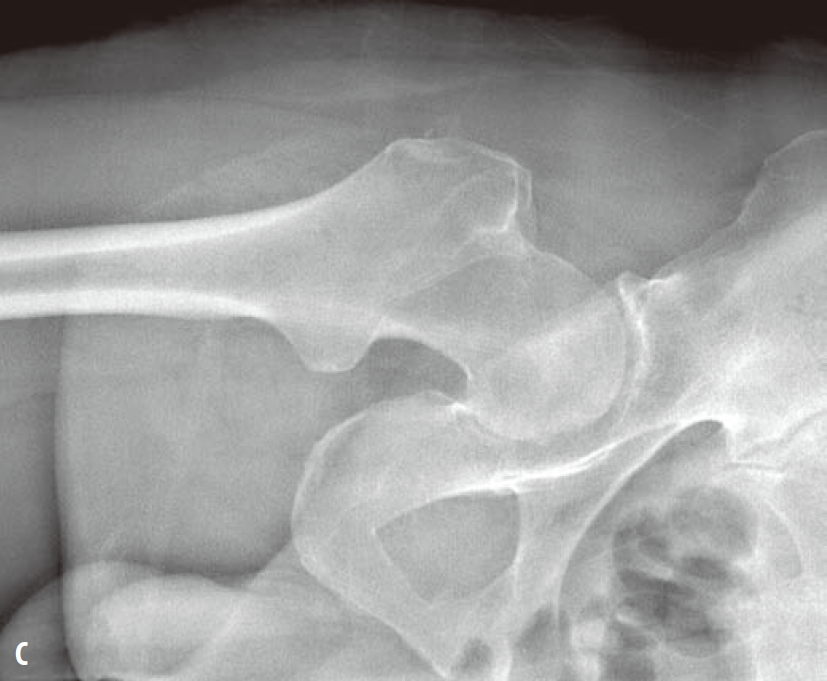 关节钳怎么用[易错与误判] “髋关节撞击综合征：凸轮型与钳型”的相关临床知识、影像表现及鉴别诊断（建议收藏）_https://www.jmylbn.com_新闻资讯_第4张