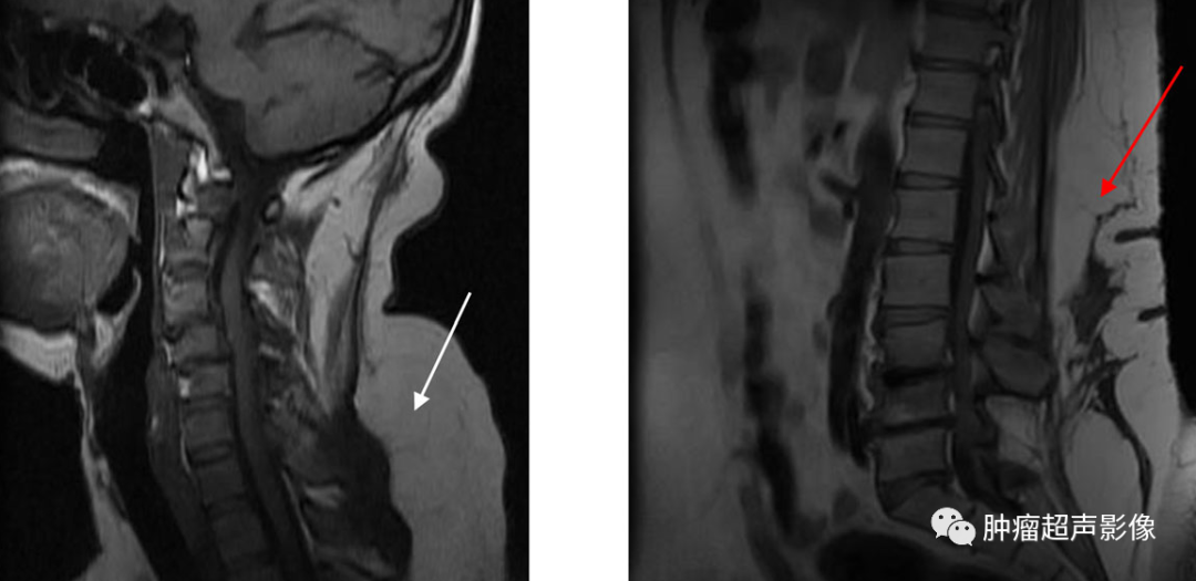 马德龙病的超声表现