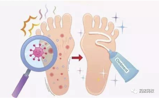 手足癣的症状、联合用药及注意事项，你都知道吗？-690