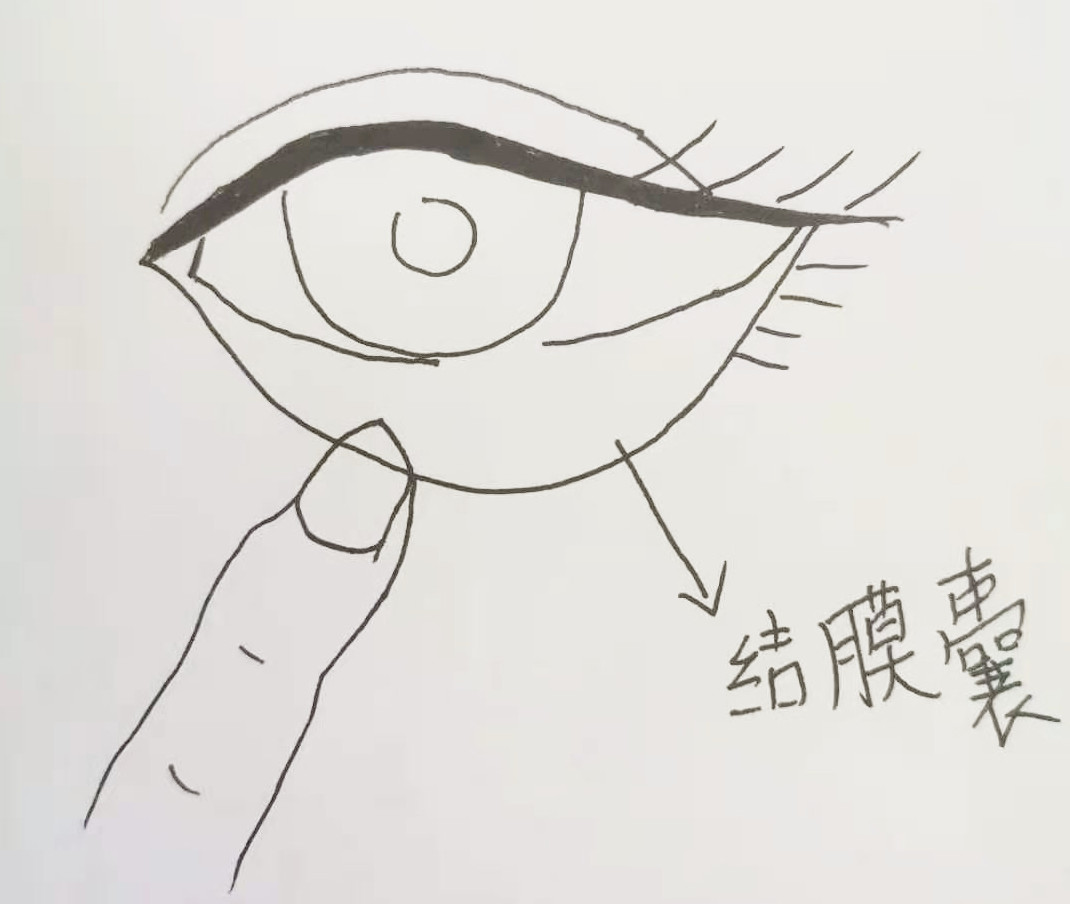 其实是下眼睑和眼球之间的结膜囊内.