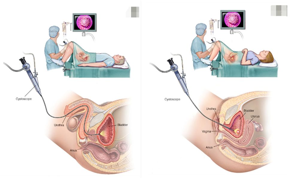 b膀胱镜为什么消毒膀胱镜检查的操作流程以及并发症处理！ ｜ 临床必备_https://www.jmylbn.com_新闻资讯_第2张