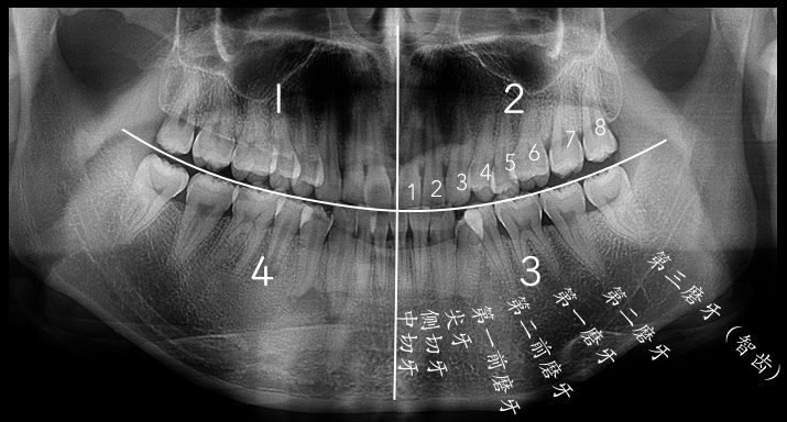 拔智齿费用不同？这里有个收费依据