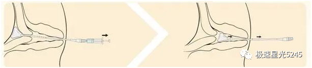 子宫球囊支架怎么取很多临床在使用球囊子宫支架都会存在操作误区，竹海生物一次性使用三角球囊支架正确操作解读_https://www.jmylbn.com_新闻资讯_第7张