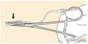 子宫球囊支架怎么取很多临床在使用球囊子宫支架都会存在操作误区，竹海生物一次性使用三角球囊支架正确操作解读_https://www.jmylbn.com_新闻资讯_第2张