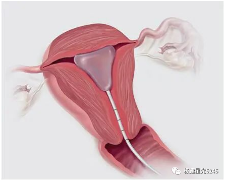 子宫球囊支架怎么取很多临床在使用球囊子宫支架都会存在操作误区，竹海生物一次性使用三角球囊支架正确操作解读_https://www.jmylbn.com_新闻资讯_第1张
