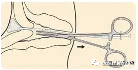 子宫球囊支架怎么取很多临床在使用球囊子宫支架都会存在操作误区，竹海生物一次性使用三角球囊支架正确操作解读_https://www.jmylbn.com_新闻资讯_第5张