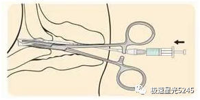 子宫球囊支架怎么取很多临床在使用球囊子宫支架都会存在操作误区，竹海生物一次性使用三角球囊支架正确操作解读_https://www.jmylbn.com_新闻资讯_第4张
